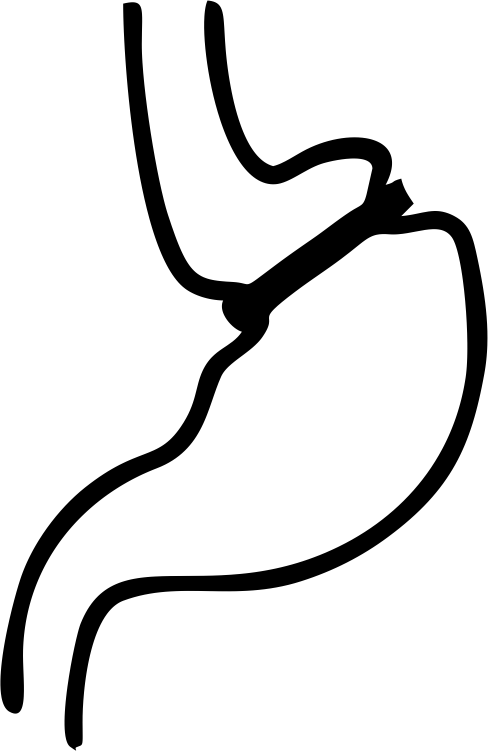 Бандажирование желудка